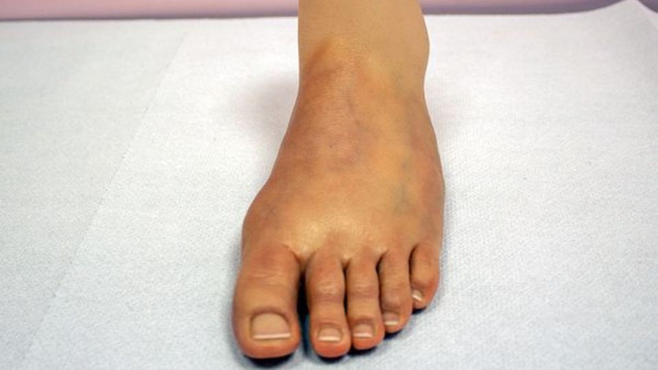 protesi piede
