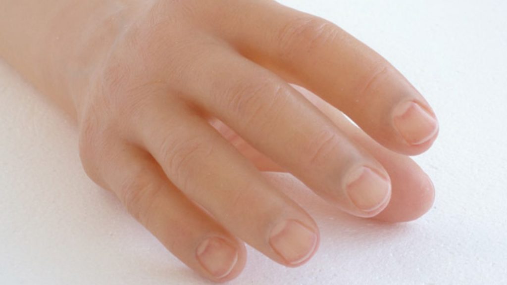 Protesi di mano in silicone: funzionalità ed estetica 